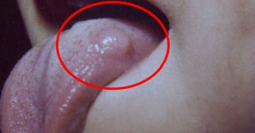 Pozor: Pokud se vám na jazyku projeví tato infekce, máte v sobě parazita!