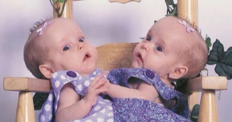 Siamská dvojčata byla rozdělena v roce 2006: Neuvěříte, jak vypadají o 20 let později