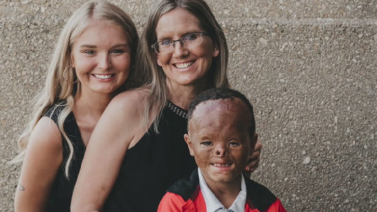 Dítě s těžkými popáleninami bylo konečně adoptováno: Trvalo to 7 let, nakonec ale získal svou vysněnou rodinu