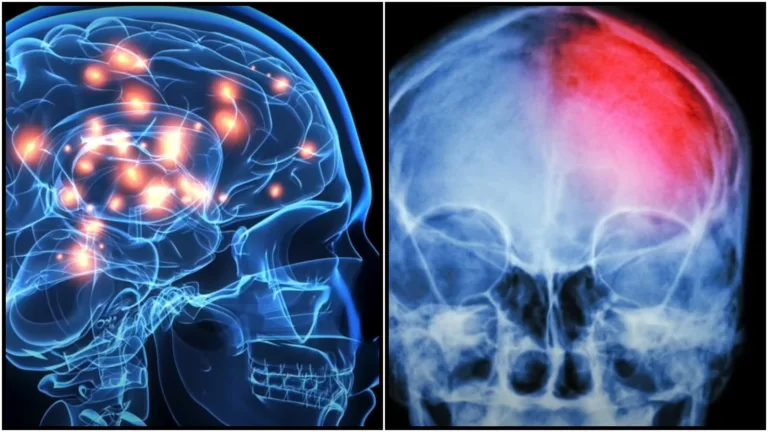 „Tajemství léků na Alzheimerovu chorobu odhaleno: mohou způsobit zmenšení mozku!