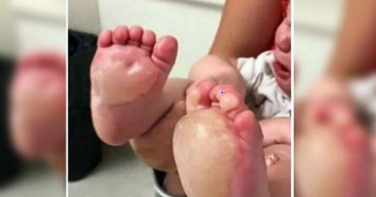 Matka viděla na nohou dítěte obrovské puchýře. Lékař jí sdělil šokující pravdu