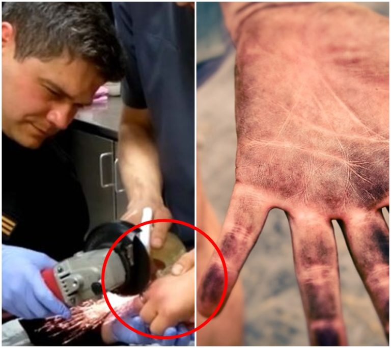 Zvrácený zásah hasičů: Neuvěřitelné co udělali s pacientovým prstem! Skandální odhalení ve zdravotnictví!