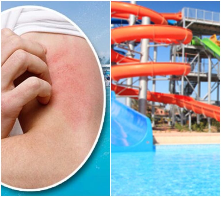 Varování! Bazénová voda vám může způsobit alergie. Tyto signály neignorujte a zjistěte, co vám hrozí!