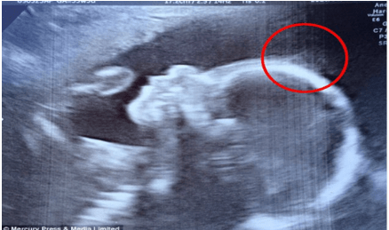 Co skutečně uviděli na ultrazvuku? Překvapující zjištění při prohlídce těhotné maminky.