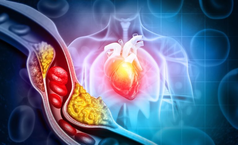 Jak se vypořádat s vysokou hladinou cholesterolu a vyhnout se srdečním onemocněním a mrtvici