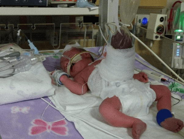 Příběh malé bojovnice: Jak lékaři zachránili novorozeně s gastroschízou!