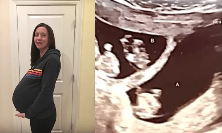 Revoluční Zvrat: Těhotná Matka S Trojčaty, Ale To, Co Zjistí Na Ultrazvuku, Překvapí Všechny Lékaře!